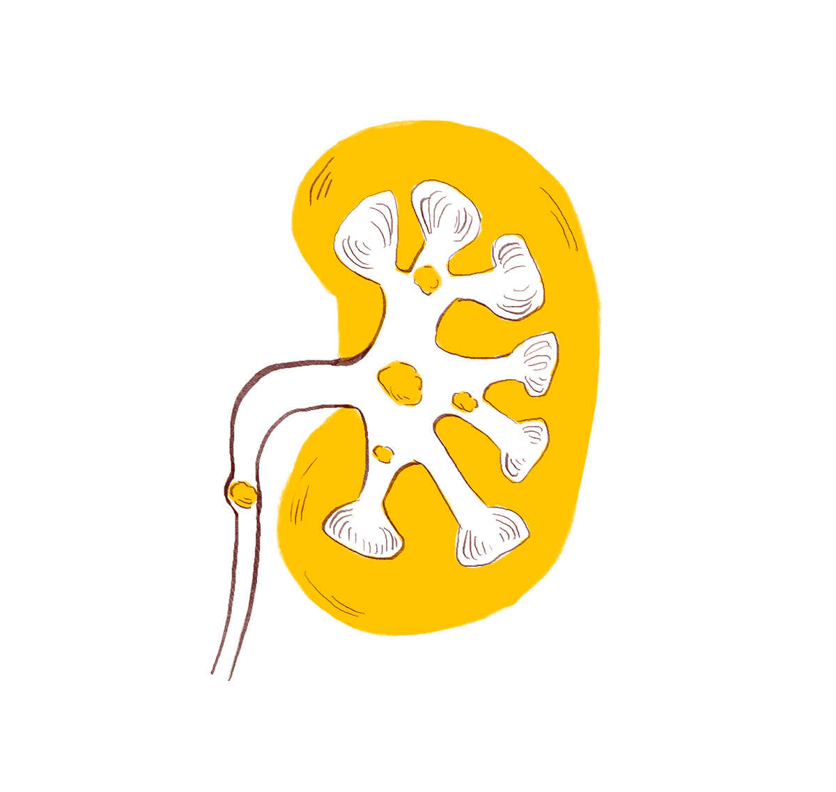 Drawing of Kidney stones