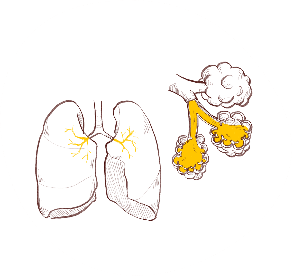 Drawing of lung complications - pneumonia